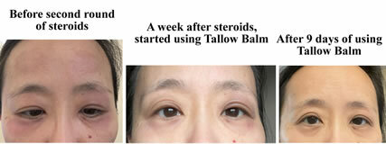 Contact Dermatitis Testimonial - Tallow Balm
