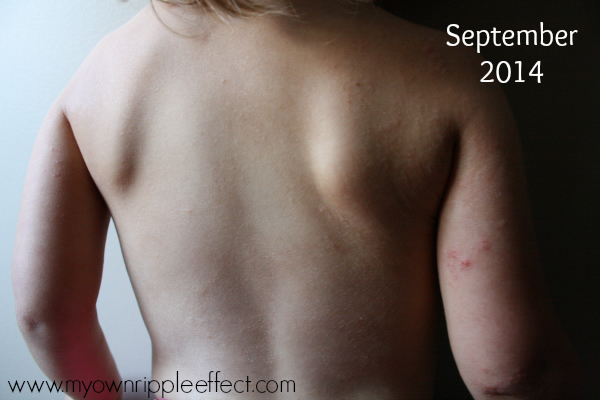 Eczema and Tallow Balm Skincare - Healing through nature
