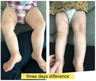 Eczema Testimonial - Tallow Balm