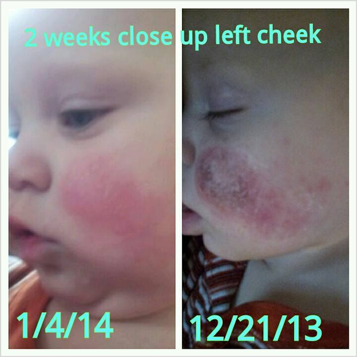 Eczema - Tallow Balm - A Mother's Picture Testimonial