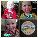 Eczema Testimonial - Tallow Balm