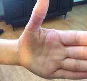 Psoriasis Testimonial - Tallow Balm