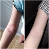 Rash Testimonial - Tallow Balm