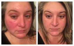 Rosacea Testimonial - Tallow Balm