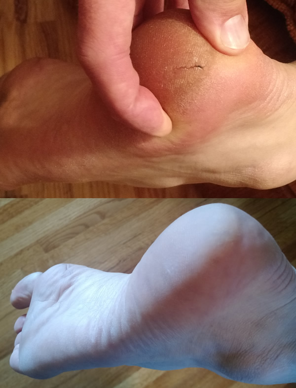 Cracked Heels and "Flip-Flop Feet" - the power of Tallow Balm for soft feet